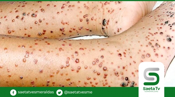 Ministerio de Salud investiga un posible caso de verruga peruana en Guayaquil