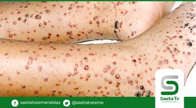 Ministerio de Salud investiga un posible caso de verruga peruana en Guayaquil